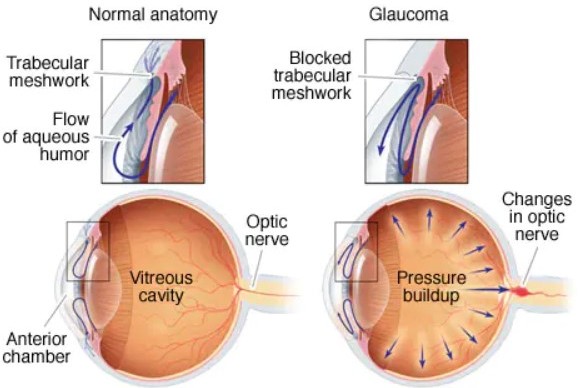 Glaucoma Review