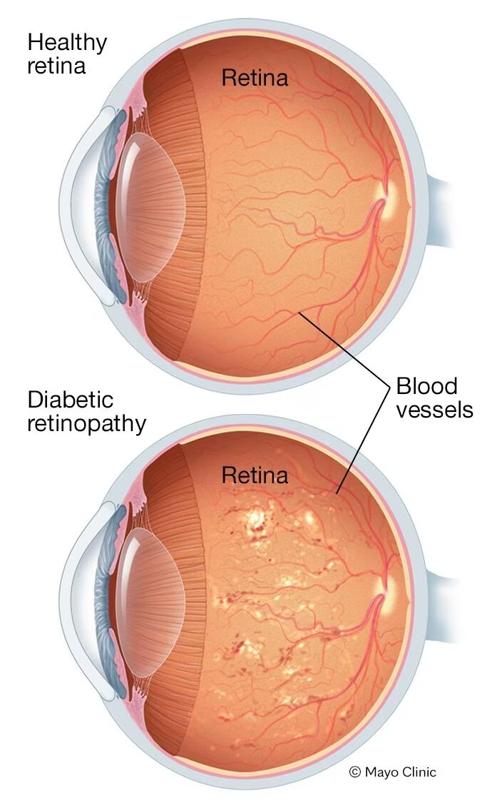 Diabetic Retinopathy
