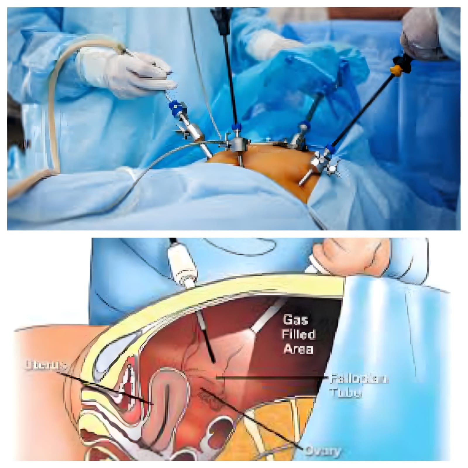 Laparoscopic & Hysteroscopy Surgery